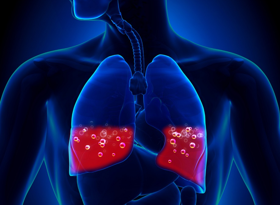 Thrombose, thrombotrac, Lungenembolie, Blutgerinsel, Schwangerschaft