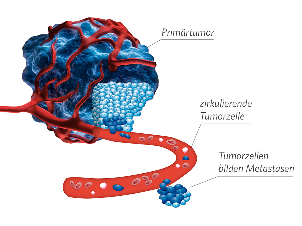 Krebserkrankung, maintrac, zirkulierende Tumrozellen, Primärtumor